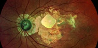 Бионический прибор нового поколения вернул зрение команде добровольцев