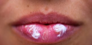 Экспериментальное лекарство от заболеваний почек и экстракт брокколи помогли усмирить герпес